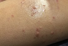 how to get rid of Molluscum Contagiosum - Home Guide Expert