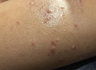 how to get rid of Molluscum Contagiosum - Home Guide Expert