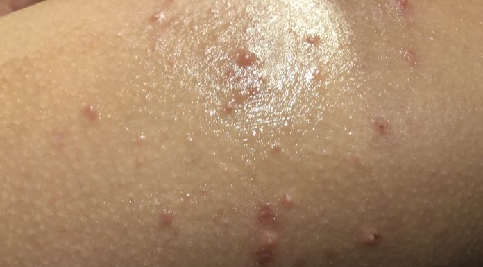 how to get rid of Molluscum Contagiosum - Home Guide Expert
