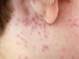 How to treat Chicken Pox - Home Guide Expert