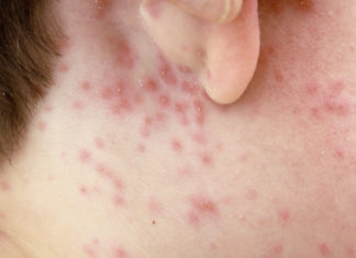 How to treat Chicken Pox - Home Guide Expert