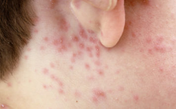 How to treat Chicken Pox - Home Guide Expert