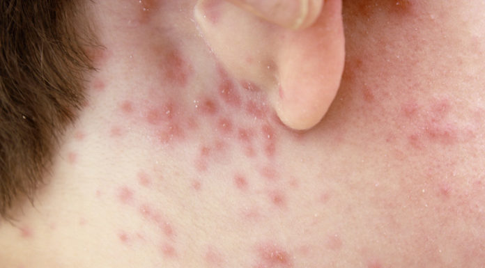 How to treat Chicken Pox - Home Guide Expert
