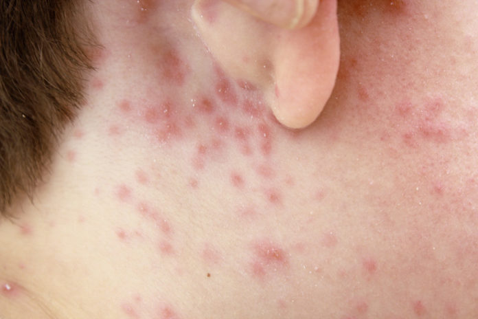 How to treat Chicken Pox - Home Guide Expert